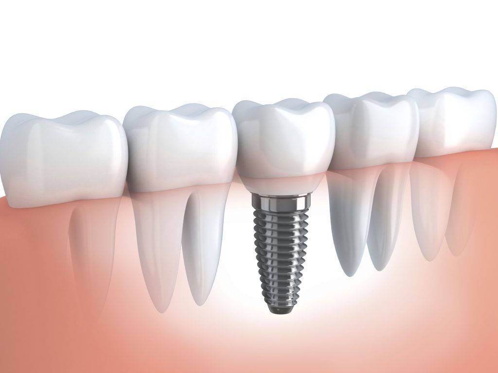 The Advantages of Availing Dental Implants - Magnolia Dental