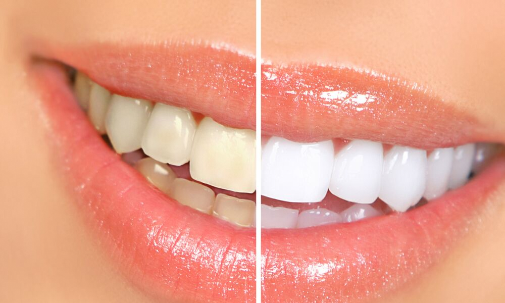 A Convenient Approach to Teeth Whitening