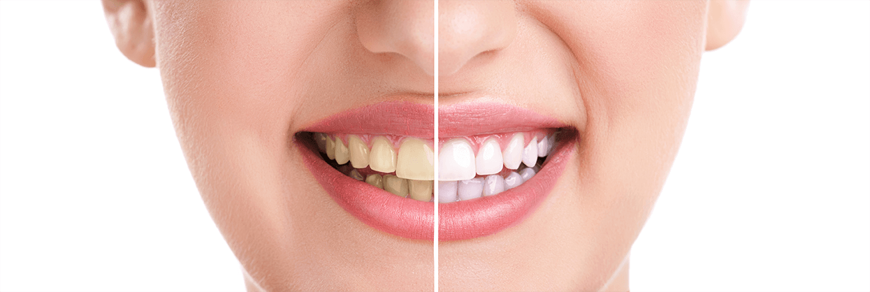 Teeth Whitening in San Luis Obispo, California