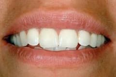 Magnolia Dental - Bonded white fillings After
