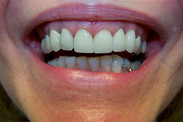 Magnolia Dental - Porcelain Crowns After