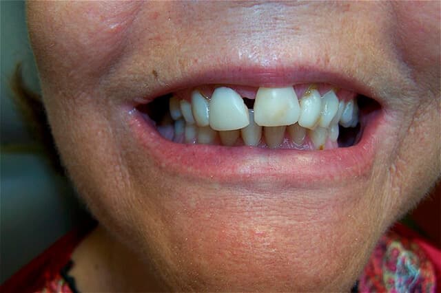Magnolia Dental - Mislagned Teeth Before